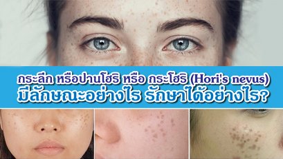 กระลึก หรือปานโฮริ หรือ กระโฮริ (Hori's nevus) มีลักษณะอย่างไร รักษาได้อย่างไร?